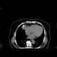 Mediastinal tumour, RFA: CT - Computed tomography